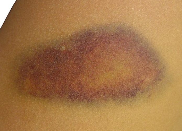 Como Tratar N doas Negras E Feridas No Corpo Mulher Portuguesa como-tratar-n-doas-negras-e-feridas-no-corpo-mulher-portuguesa