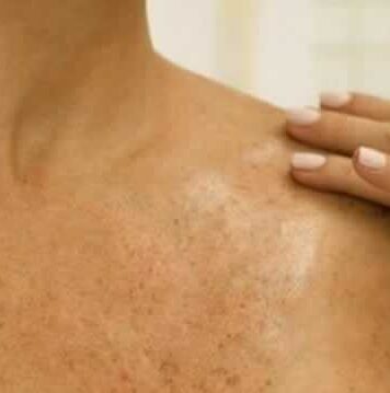 Fim das manchas na pele Manchas na pele