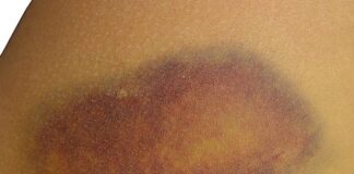 Como tratar nódoas negras e feridas no corpo