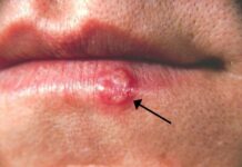 Herpes labial