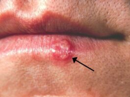 Herpes labial