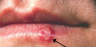 Herpes labial