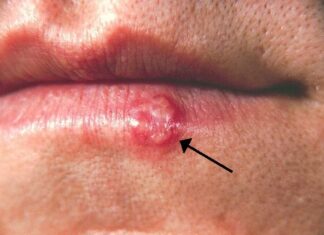 Herpes labial