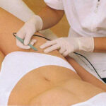 Eletrólise: Depilação Eléctrica Electrólise - depilação eléctrica