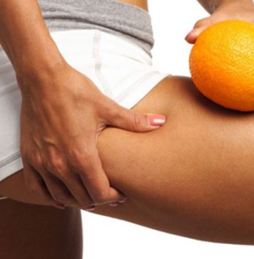 Carboxiterapia no combate à celulite e estrias Carboxiterapia no combate à celulite e estrias