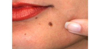 Como prevenir o cancro da pele