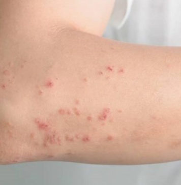 Dermatite, mais conhecida como as escamas corporais Dermatite