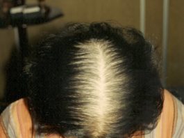 A calvície, conheça a causa e o tratamento para a queda do cabelo