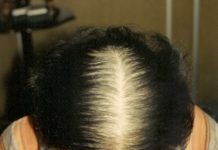 A calvície, conheça a causa e o tratamento para a queda do cabelo