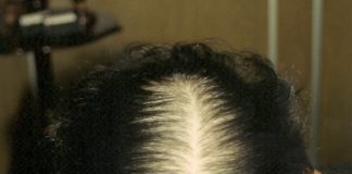 A calvície, conheça a causa e o tratamento para a queda do cabelo