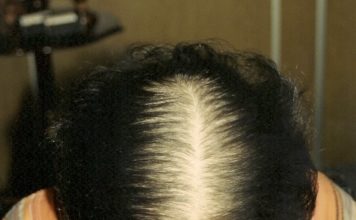 A calvície, conheça a causa e o tratamento para a queda do cabelo