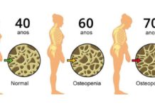 Osteoporose: Conheça melhor esta doença