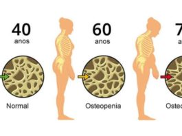 Osteoporose: Conheça melhor esta doença