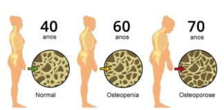 Osteoporose: Conheça melhor esta doença