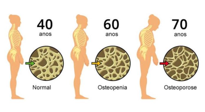 Osteoporose: Conheça melhor esta doença