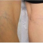 Varizes: um problema de saúde e beleza