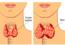 Conheça melhor as causas do Bócio
