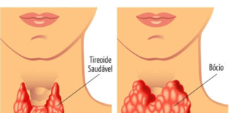 Conheça melhor as causas do Bócio