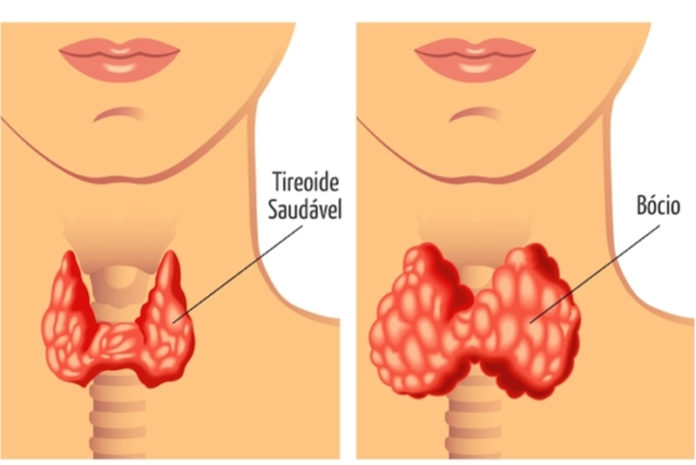Conheça melhor as causas do Bócio