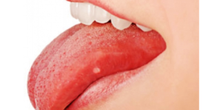 Prevenir o aparecimento de aftas