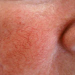 Couperose - o rubor da face em pessoas de pele sensível
