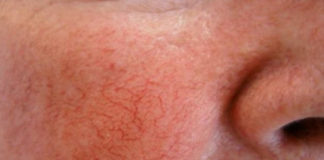 Couperose - o rubor da face em pessoas de pele sensível