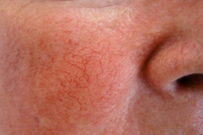 Couperose - o rubor da face em pessoas de pele sensível