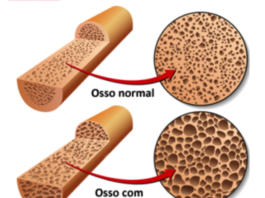 Osteoporoso, afeta mais as mulheres do que os homens