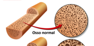 Osteoporoso, afeta mais as mulheres do que os homens