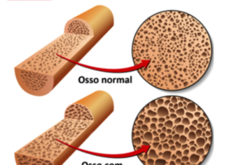 Osteoporoso, afeta mais as mulheres do que os homens