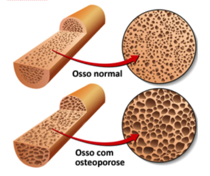 Osteoporoso, afeta mais as mulheres do que os homens