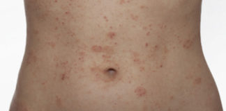 Psoríase, como tratar esta doença de pele