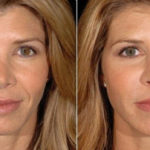 Botox: novas feições em alguns dias