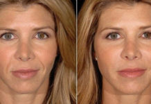 Botox: novas feições em alguns dias