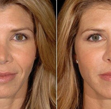 Botox: novas feições em alguns dias